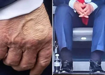 Perezida Donald Trump yagaragayeho indwara y’imitsi iteza kubyimba amaguru