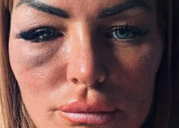 Ingumi imwe yahinduye burundu ubuzima bw’umugore