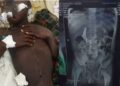 Uganda: Umugore yafunzwe azira guha Umwana inshinge 46 mu rukozasoni rwateye abaturage umujinya